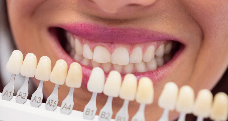 primer plano de boca mujer con gama de tonalidades dentales ¿Cuál es el mejor blanqueamiento dental?